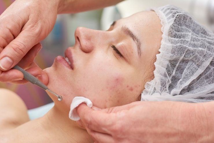 Acne-Treatment