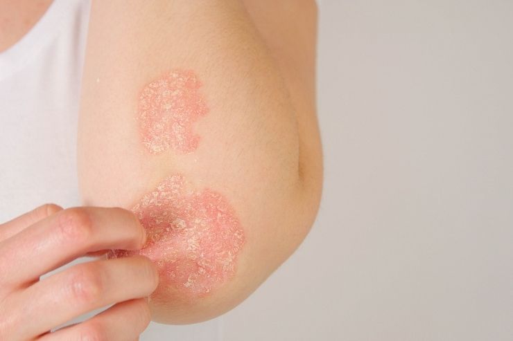 Eczema