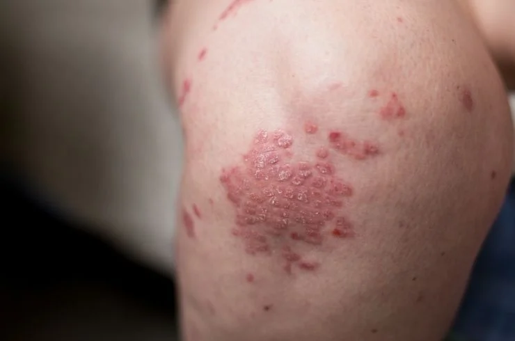 Psoriasis