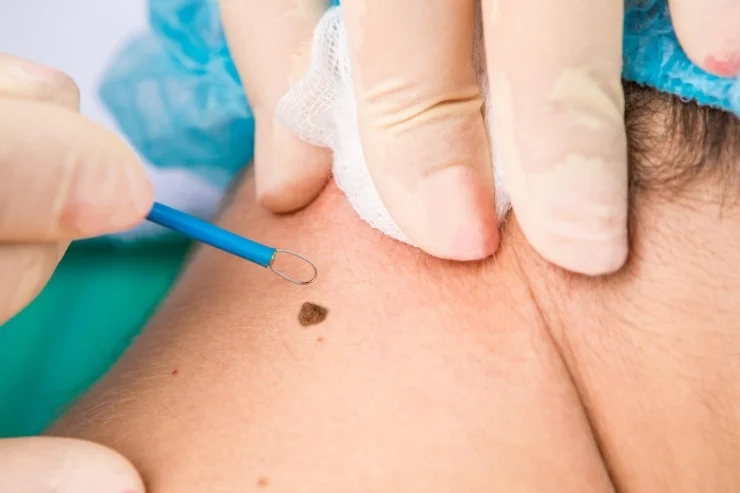 Sentinel Tag _ Anal Skin Tag Removal