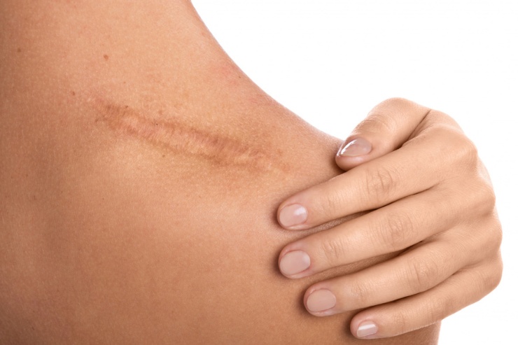 Scar Remodeling