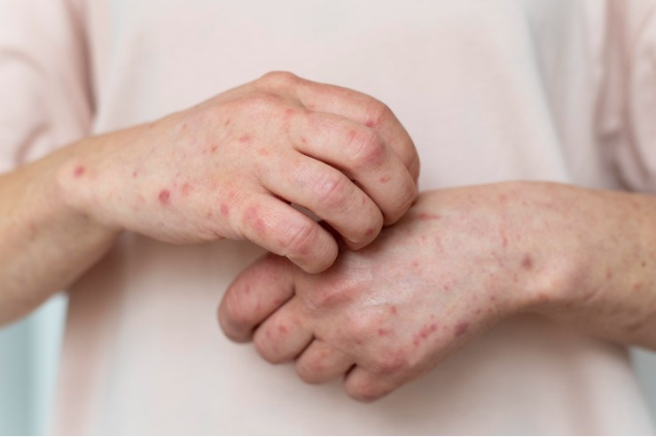 Skin Allergies