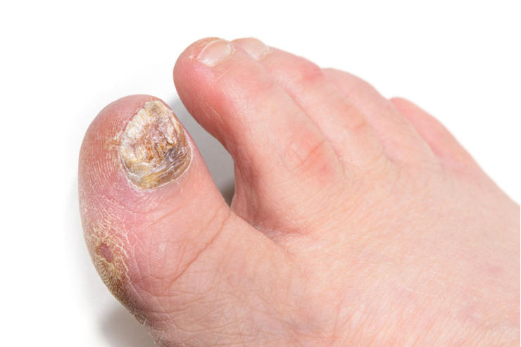 Nail Disorders
