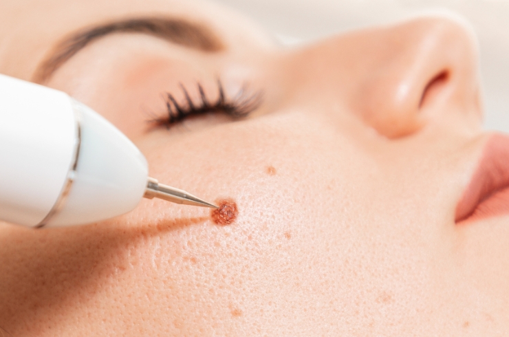 Warts Removal